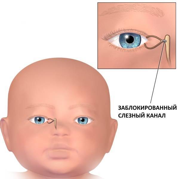 Дакриоцистит у детей - симптомы болезни, профилактика и лечение дакриоцистита у детей, причины заболевания и его диагностика на eurolab