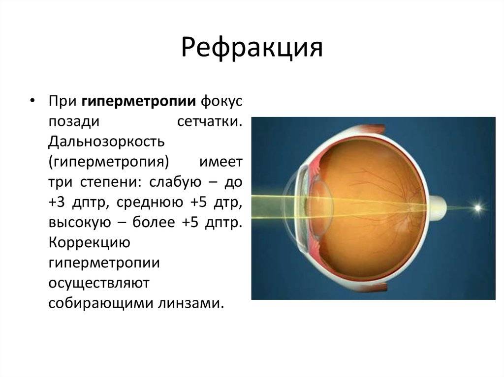 Миопический астигматизм обоих глаз, лечение сложного миопическиого астигматизма в клинике fedorovmedcenter.ru