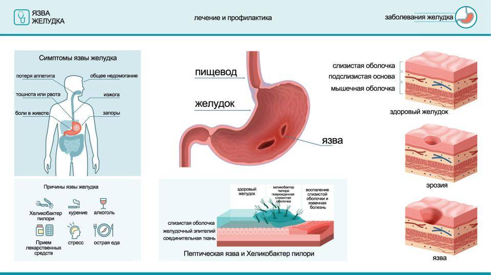 Язвенная болезнь желудка и 12-перстной кишки: лечение и диагностика симптомов, причин в москве