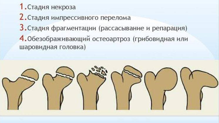 Болезнь пертеса - лечение, симптомы, причины, диагностика | центр дикуля