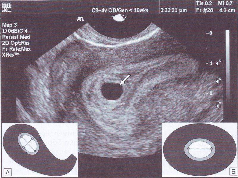 Первое узи при беременности: плановое и неплановое исследования