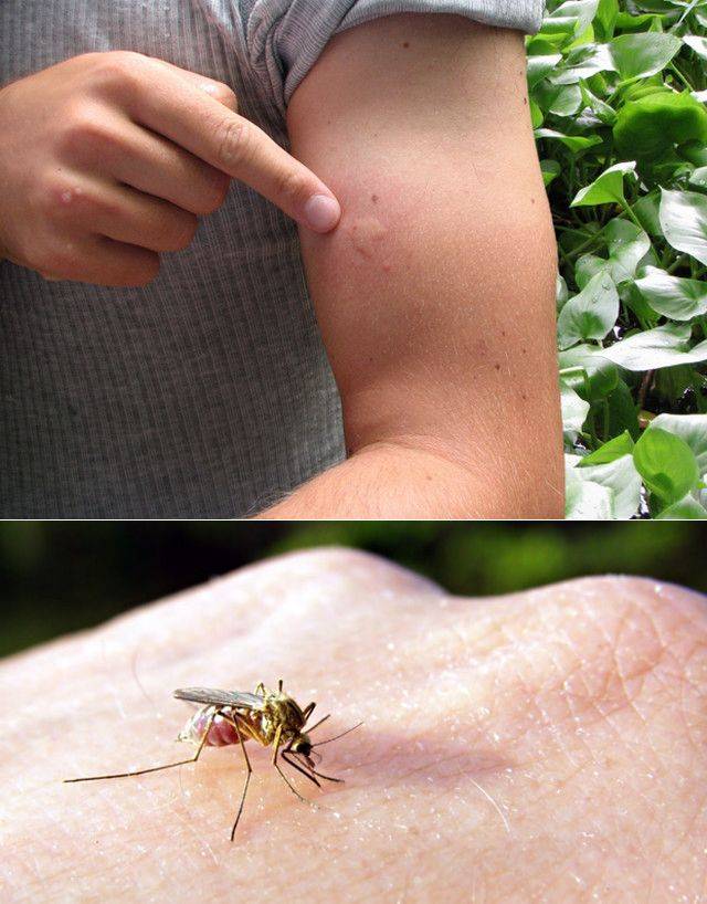 Ребенок расчесал укус комара до ранки и занес инфекцию - чем обработать?