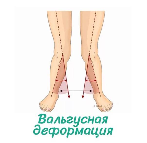 Удаление косточки на ноге лазером – цена операции в клинике санкт-петербурга