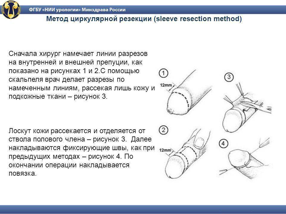 Заболевания крайней плоти