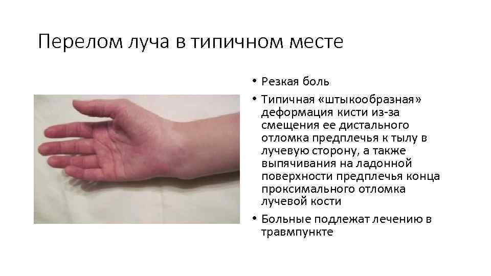 Перелом руки у ребенка: симптомы и первая помощь