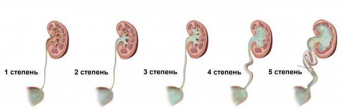 Лечение гипоплазии почки в германии - клинический случай
