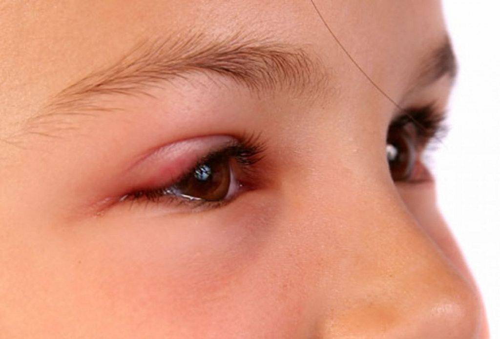 Ячмень на веке глаза: причины появления, лечение, вскрытие ячменя.