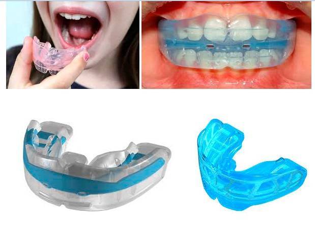 Особенности установки и ношения пластин для выравнивания зубов