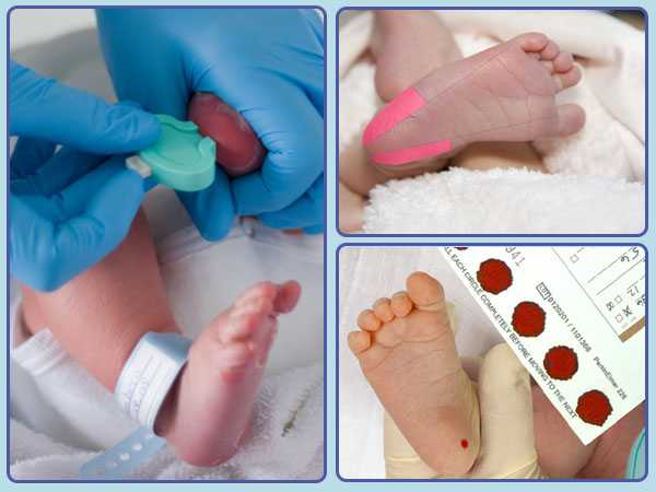 Неонатальный скрининг новорожденных - выявление врожденного или наследственного заболевания у малыша