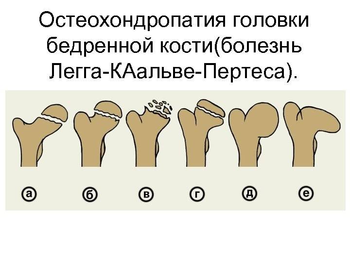 Выбор метода лечения при дисплазии тазобедренных суставов