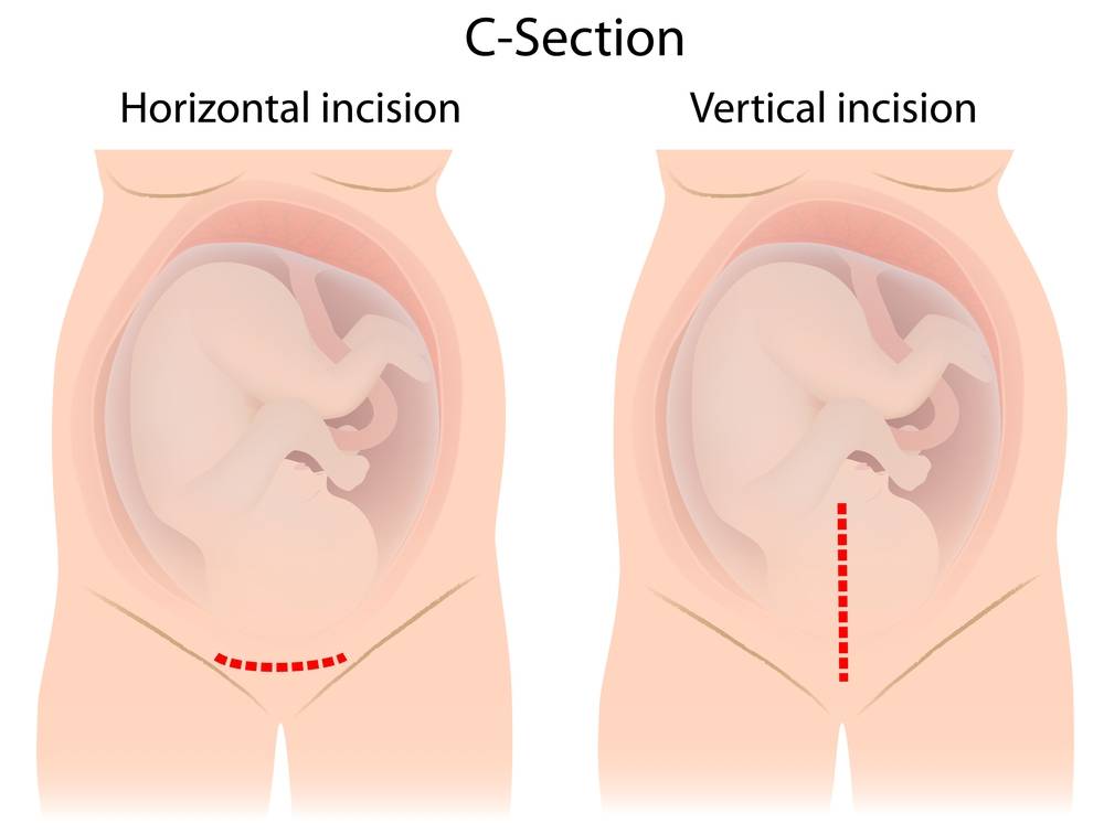 Малышок сайт для беременных, молодых родителей, будущих мам | предлежание плаценты и кесарево сечение