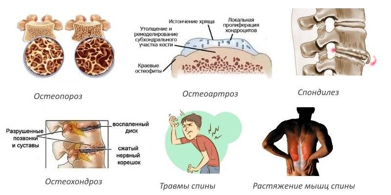 Остеопения