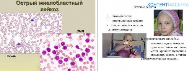 Хронический лейкоз                (хронический лимфоцитарный лейкоз, хронический миелоидный лейкоз, рак крови)