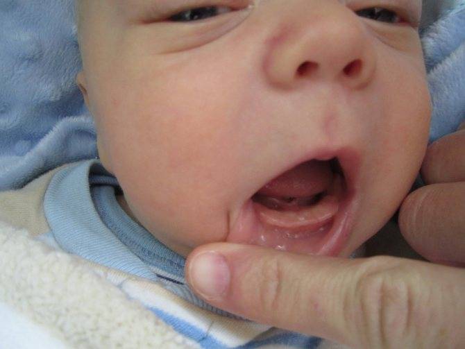 Крошатся зубы у ребенка: в чем причина, как лечить, как предотвратить разрушение