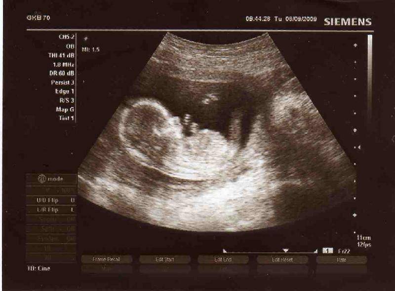 4 неделя беременности от зачатия: что происходит с малышом и мамой, каковы ощущения женщины?