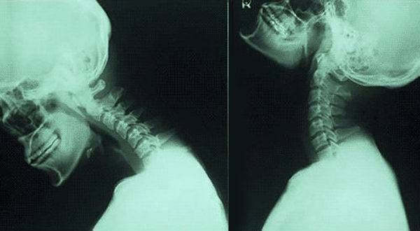 Проблемы шейного отдела позвоночника. от чего болит шея