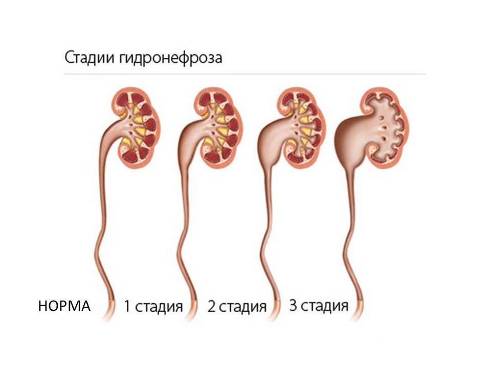 Гидронефроз у детей — лечение, диагностика, симптомы и причины болезни | николаев в.в.