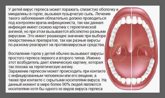 Виды ангины