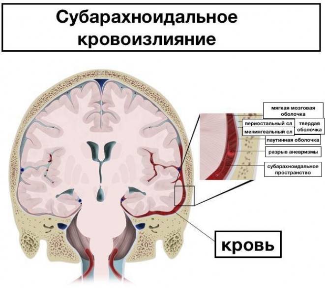 Лобный синусит (фронтит)
