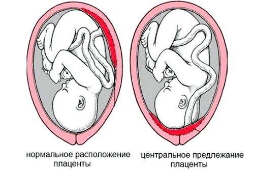Краевое предлежание плаценты по задней стенке или передней: прогноз родов при опасном диагнозе