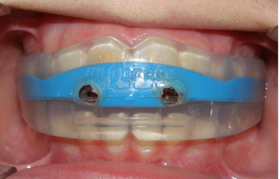Установка пластинок на зубы