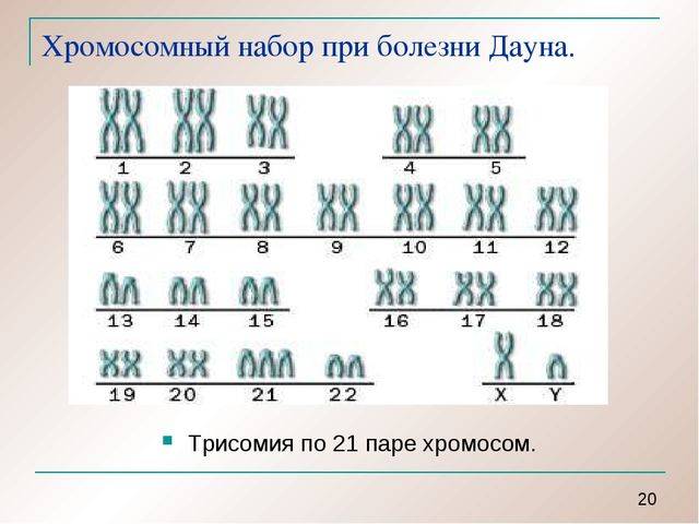 Схема хромосомного набора. Синдром Дауна трисомия 21 хромосомы. Синдром Дауна трисомия по 21 хромосоме. Синдром Дауна (трисомия по 21 паре хромосом). Синдром Дауна трисомия по 21-й хромосоме.