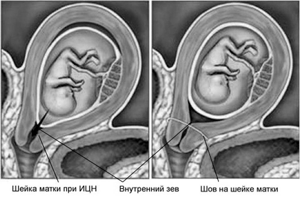Внутренний зев сомкнут при беременности: что это значит