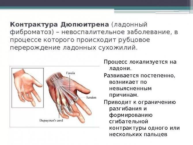 Безоперационное лечение щелкающего пальца (болезнь нотта)
