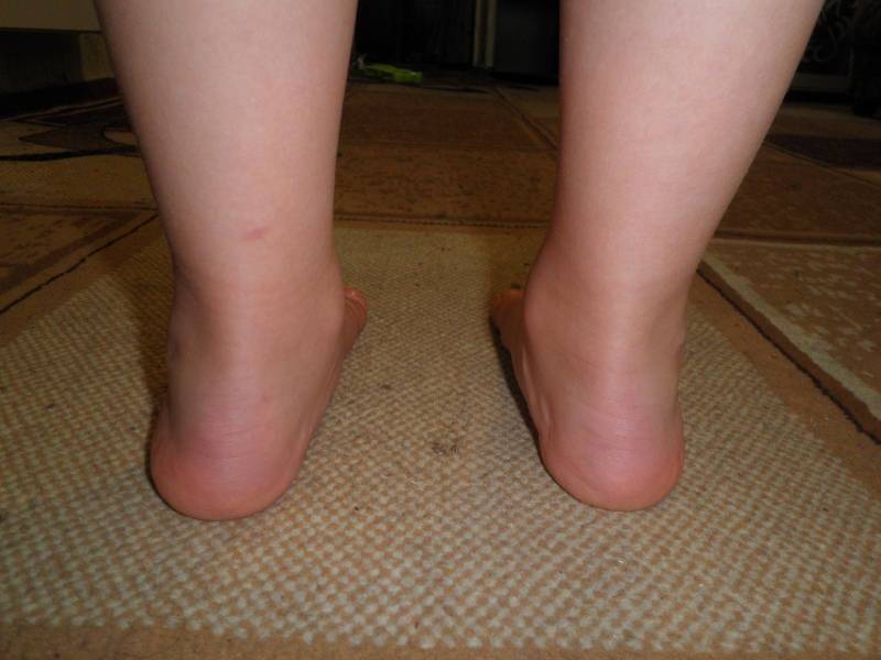 Вальгусная деформация стопы у детей лечение и профилактика
