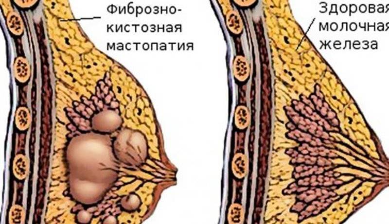 Диффузная фиброзно-кистозная мастопатия: как лечить фиброзно-кистозную мастопатию молочной железы? | мкдц фгбну нцн