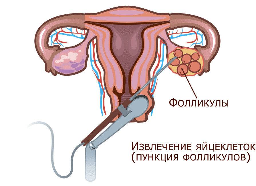 Экстракорпоральное оплодотворение: этапы по дням цикла