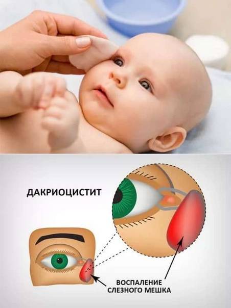Массаж слёзного канала при дакриоцистите у новорожденных - что думает доктор комаровский?