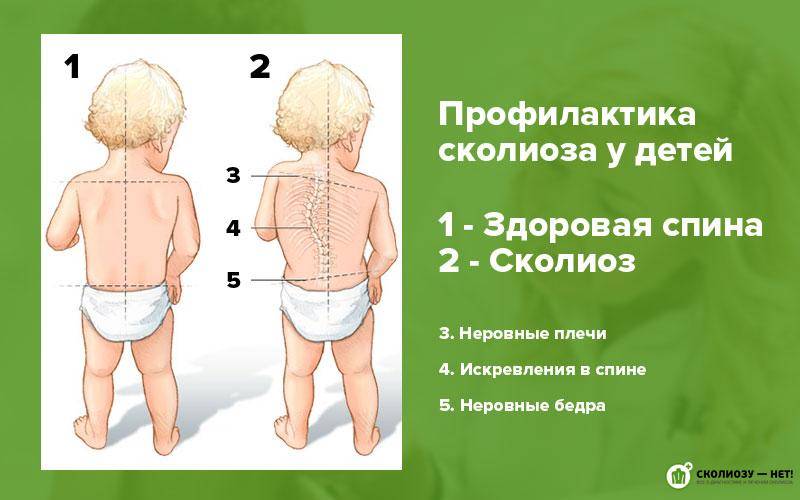 Нарушение осанки и сколиоз у детей: информация для родителей - бу "сургутская городская клиническая поликлиника №2"