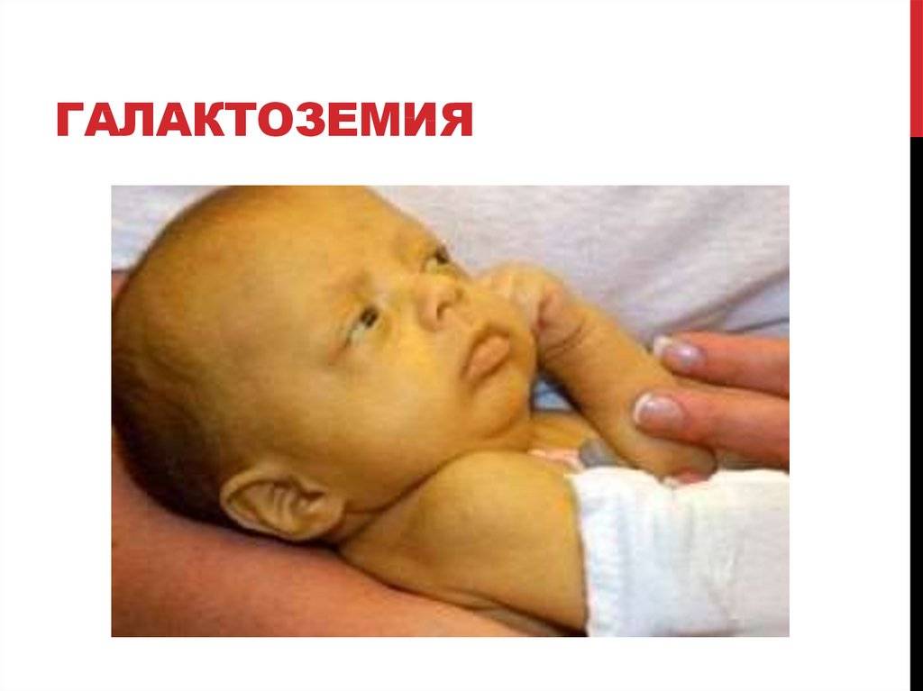 Галактоземия