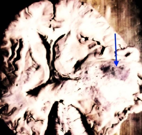 Опухоли головного мозга — симптомы и способы лечения опухоли головного мозга в клинике целт