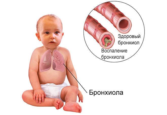 Симптомы бронхита у грудных детей (лечение)