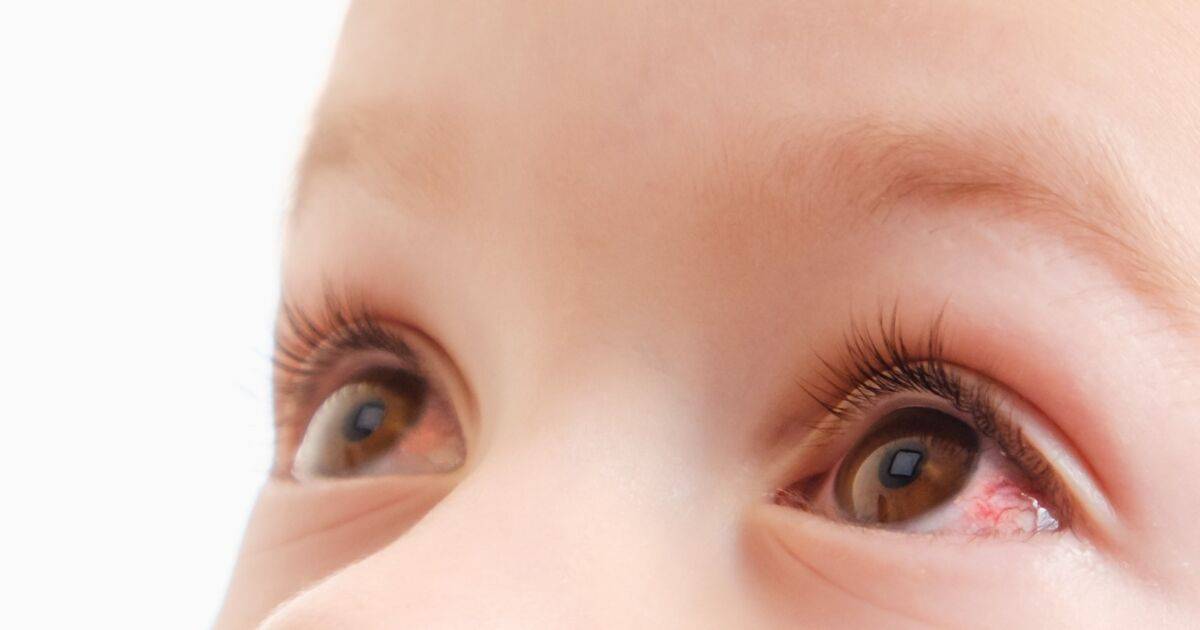 Покраснение глаз у детей