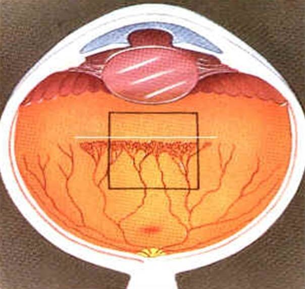 Задняя агрессивная ретинопатия у недоношенных младенцев