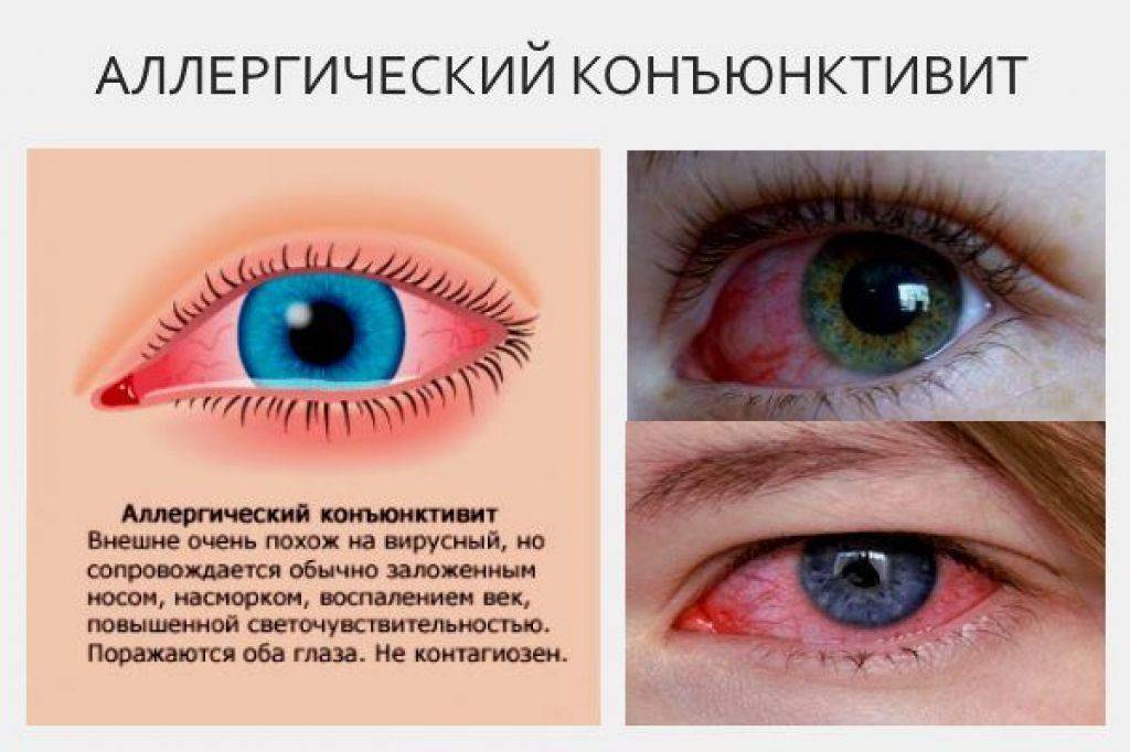 Красные сосуды в глазах: причины, лечение, профилактика «ochkov.net»