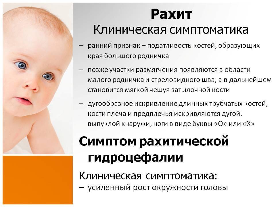 Рахит у грудничков: симптомы и лечение у детей до 1 года и старше, профилактика