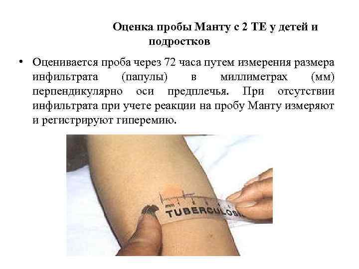 На какой день смотрят реакцию манту. все о прививках. sovet-medika.ru