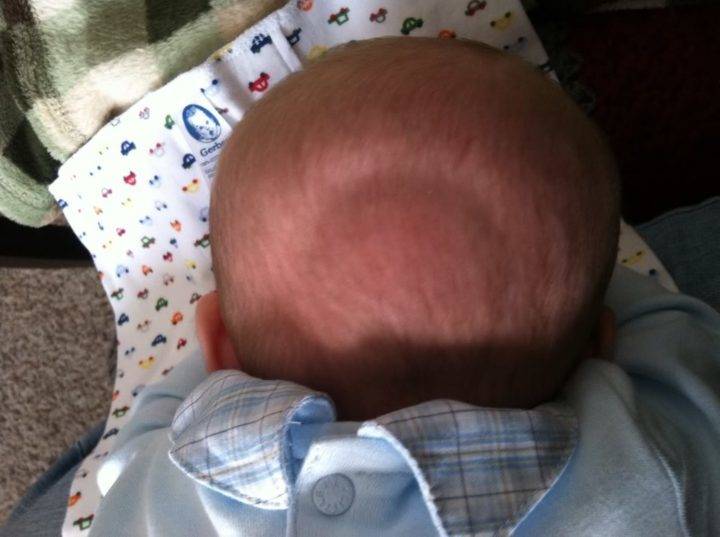 Маленький родничок у новорожденного: последствия раннего закрытия темечка