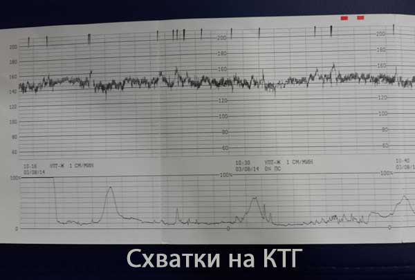 Фото ктг со схватками как выглядит