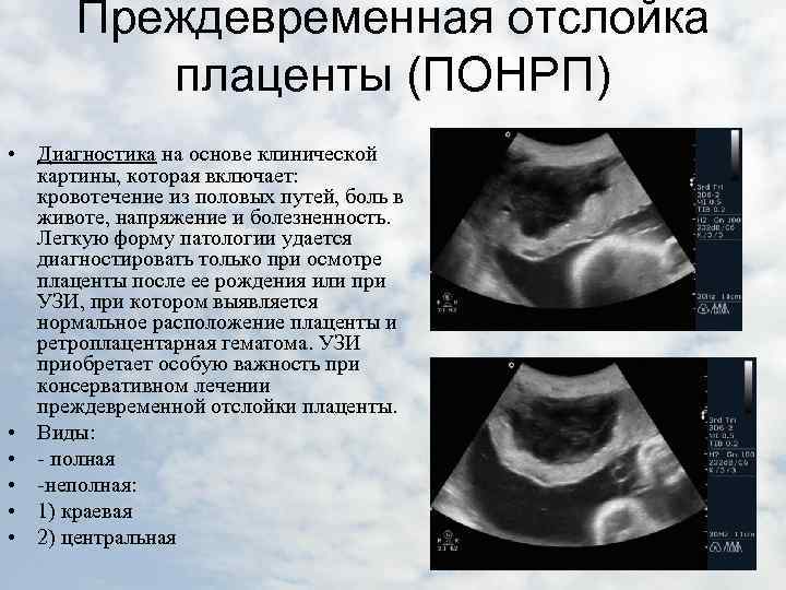 Выкидыш на раннем сроке фото 5 недель