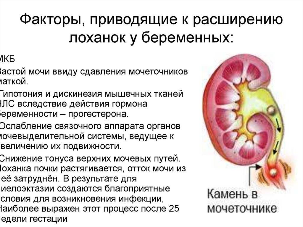Пиелоэктазия