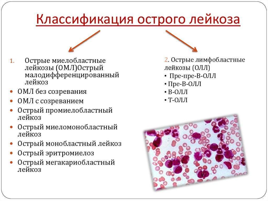 Острый лейкоз у взрослых