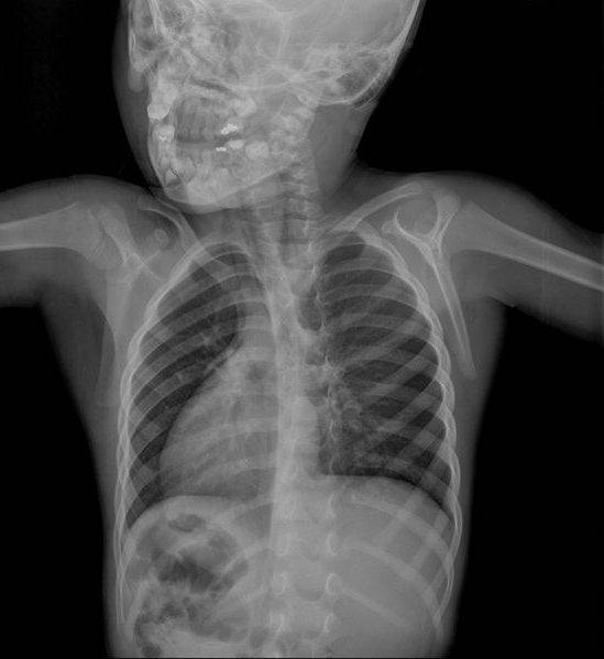 Рентген грудной клетки - зачем и как он проводится. где сделать рентген грудной клетки.