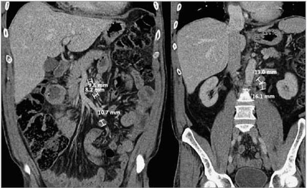 Рентгенография брюшной полости. исследование на кишечную непроходимость