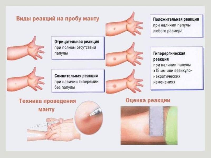 Через какое время проявляется след от манту? - запись пользователя эвелина (id1361607) в сообществе детские болезни от года до трех в категории прививки - babyblog.ru