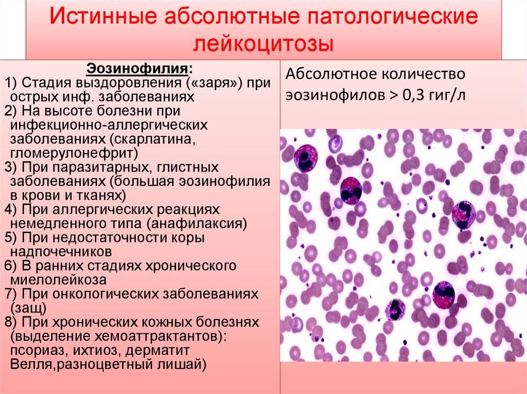 О чем говорят повышенные лейкоциты в анализе крови?